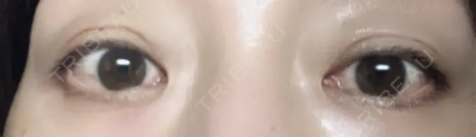 二重埋没 小倉美容外科ネビュラクリニック DAY 1 メイン用