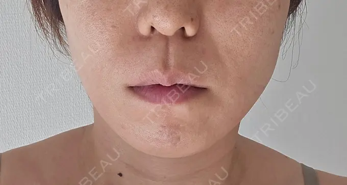 RF（高周波）たるみ治療 ゆきスキンクリニック 東池袋 AFTER メイン用