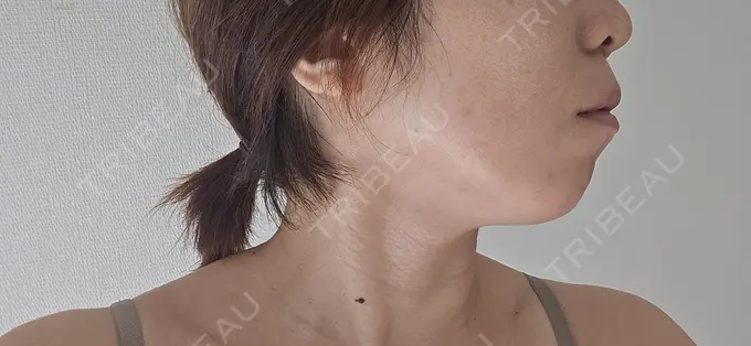 RF（高周波）たるみ治療 ゆきスキンクリニック 東池袋 DAY 10 メイン用