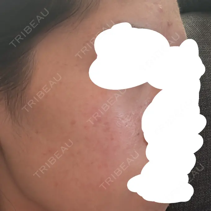 アグネス / ニキビ治療 日本ウェルネス再生クリニック DAY 5 メイン用