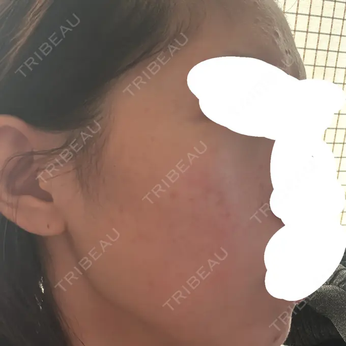 アグネス / ニキビ治療 日本ウェルネス再生クリニック AFTER メイン用