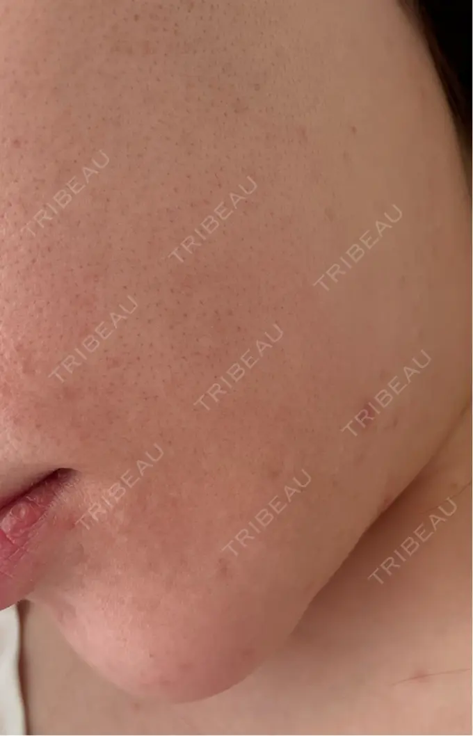 ピーリング（ニキビ・毛穴） / フォトRF / 光治療（フォトフェイシャルなど） / ピーリング（ハリ・ツヤ） DAILY SKIN CLINIC 心斎橋院 AFTER メイン用