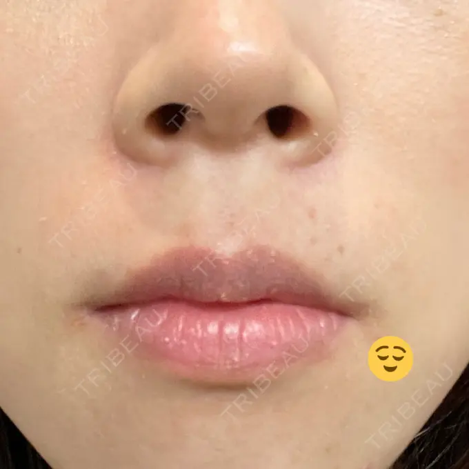 ピーリング（ニキビ・毛穴） Sea Sail Beauty Clinic AFTER メイン用