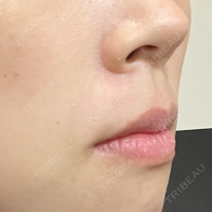 ピーリング（ニキビ・毛穴） Sea Sail Beauty Clinic DAY 3 メイン用