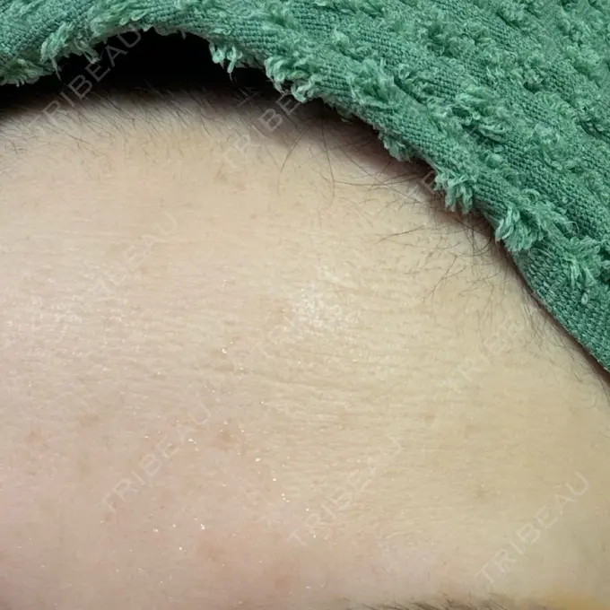 ルメッカ 東京美容外科 秋田院 AFTER メイン用