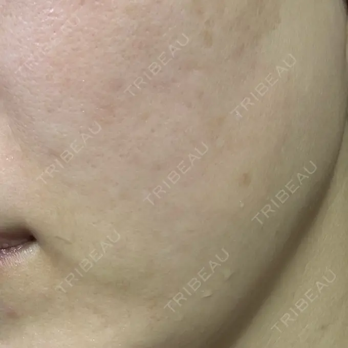 ルメッカ 東京美容外科 秋田院 DAY 9 メイン用