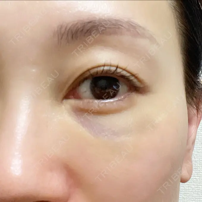 肌ヒアルロン酸注入（たるみ・シワ改善） しのぶ皮膚科 DAY 1 メイン用