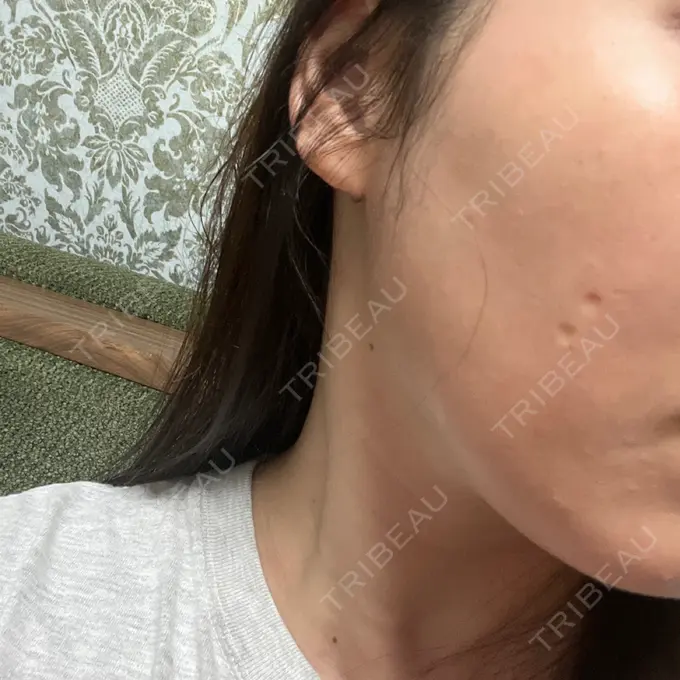 光治療（フォトフェイシャルなど） Sea Sail Beauty Clinic AFTER メイン用