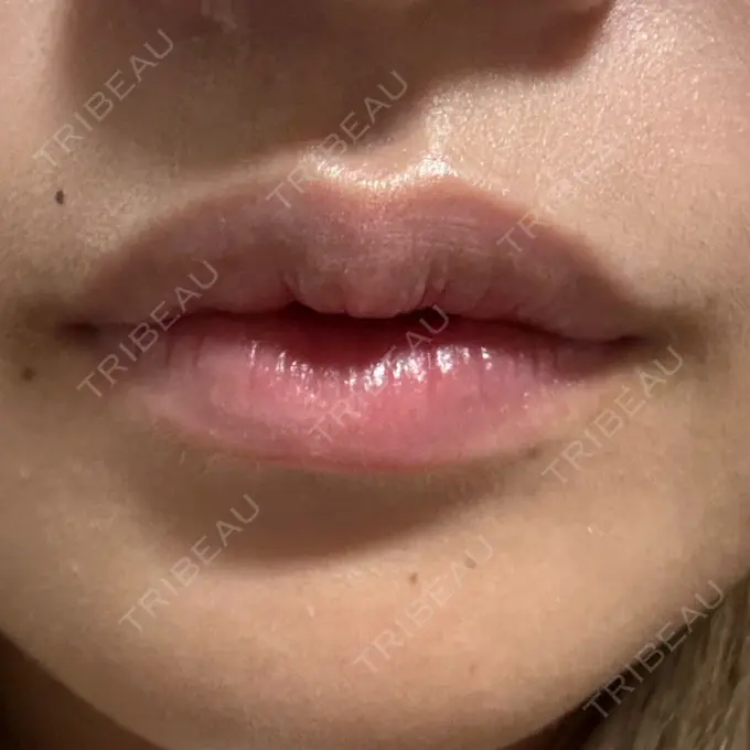 ボトックス（口角） / ボトックス（額） 大美会クリニック 神戸院 AFTER メイン用