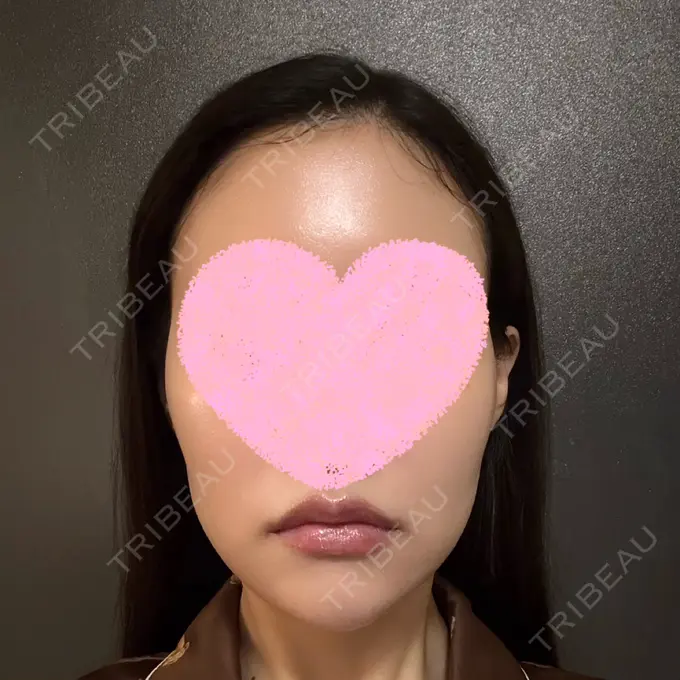 骨切り（あご） / 脂肪吸引（顔） WOM CLINIC GINZA （ワム クリニック ギンザ） DAY 25 メイン用