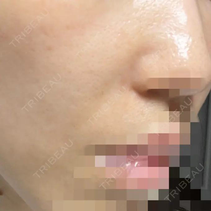 ヒアルロン酸注入（鼻翼基部） BiBiクリニック DAY 10 メイン用