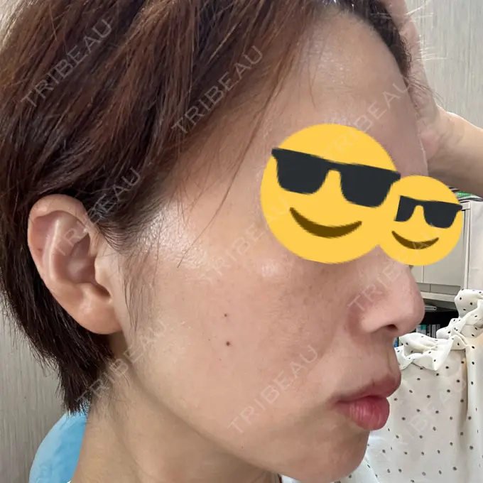 ルメッカ 東京美容外科 池袋院 DAY 2 メイン用