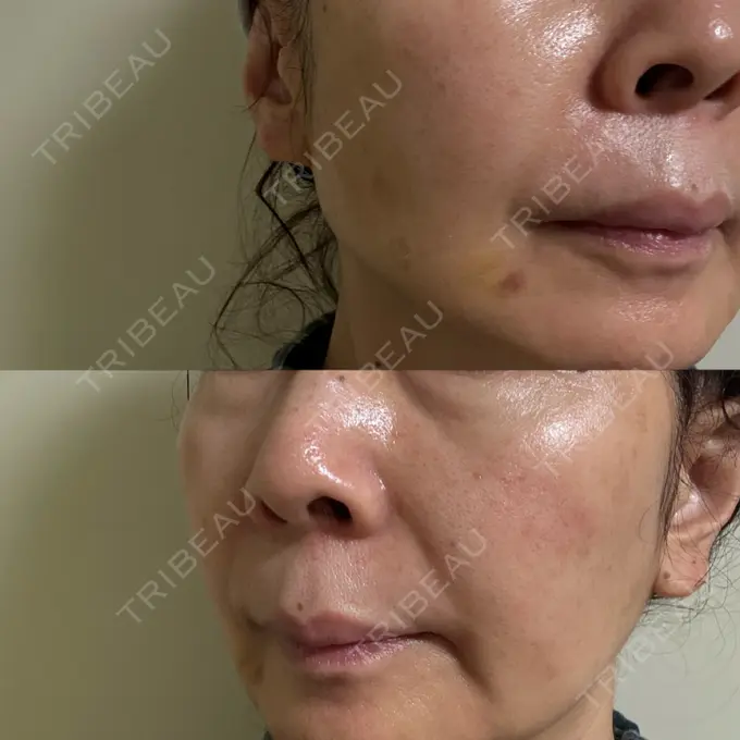 肌ヒアルロン酸注入（たるみ・シワ改善） / ヒアルロン酸注入（頬） / その他（口元） LIKI CLINIC KOBE DAY 26 メイン用