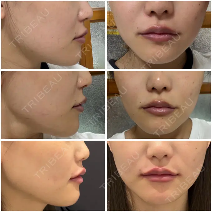 ボトックス（あご） / ヒアルロン酸注入（唇） YBC横浜美容外科 立川院 DAY 8 メイン用