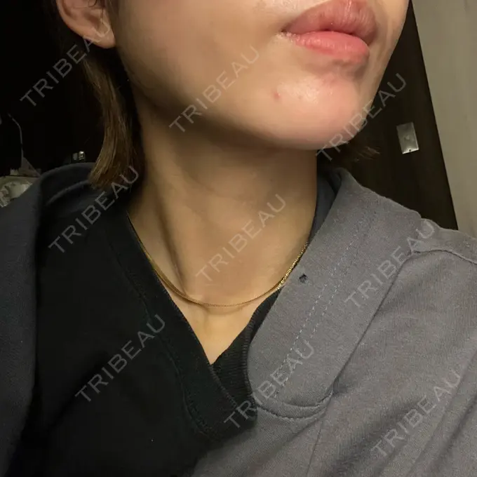 糸リフト / 脂肪吸引（顔） / ジョールファット除去 アリエル美容クリニック 横浜院 DAY 15 メイン用