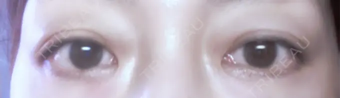 二重埋没 小倉美容外科ネビュラクリニック DAY 2 メイン用