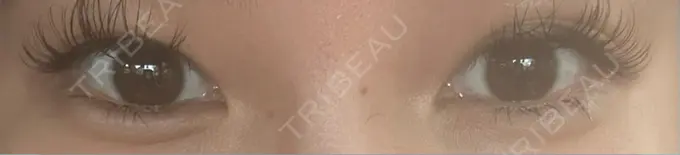 ヒアルロン酸注入（涙袋） フィラークリニック 名古屋栄院 AFTER メイン用