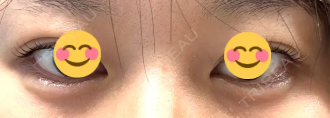 ヒアルロン酸注入（涙袋） フィラークリニック 名古屋栄院 DAY 0 メイン用