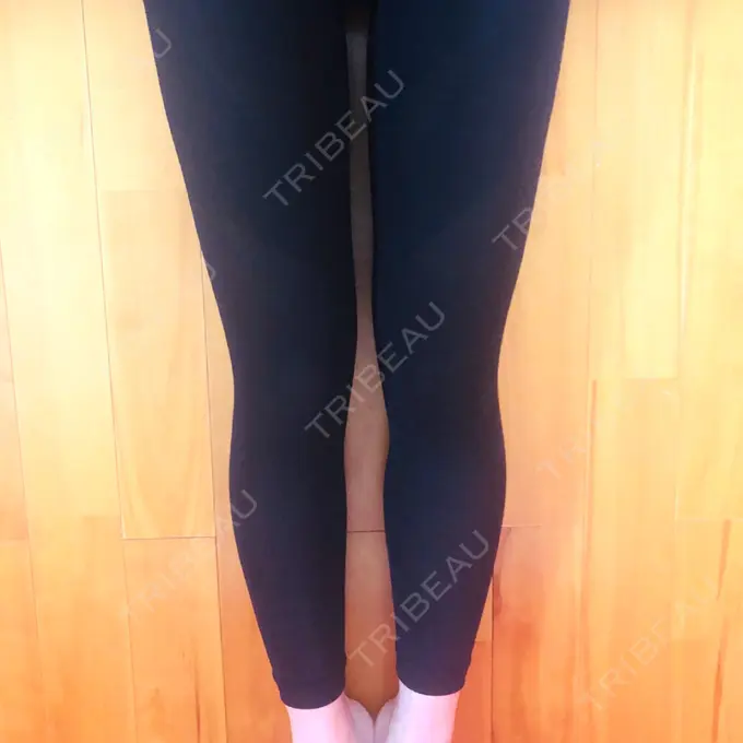 脂肪吸引（脚） THE CLINIC（ザ・クリニック） 名古屋院 DAY 21 メイン用