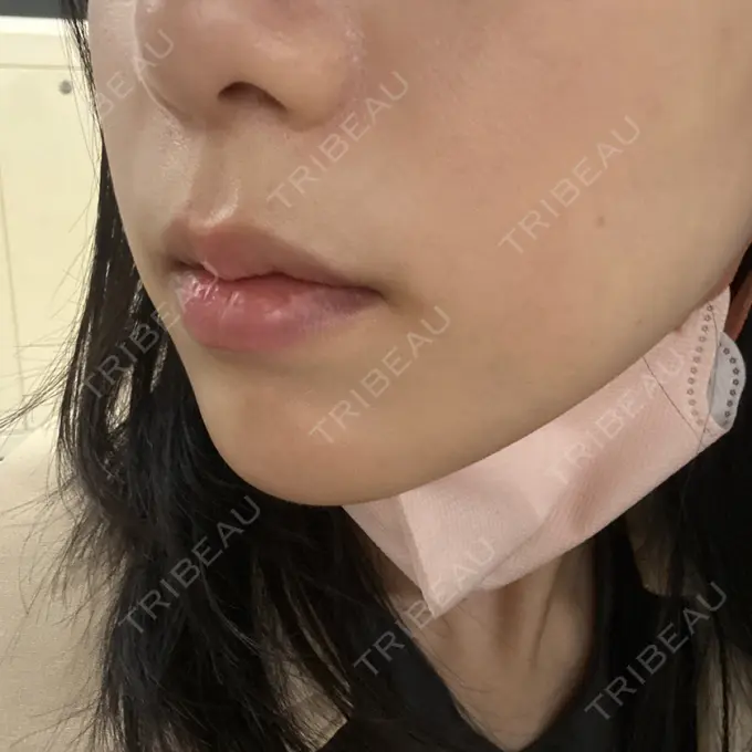 ルメッカ さっぽろ美容クリニック AFTER メイン用