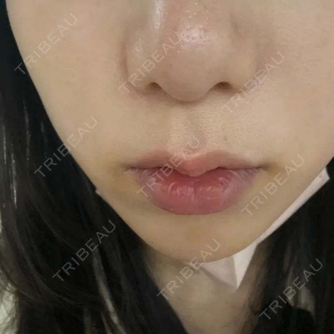 ルメッカ さっぽろ美容クリニック DAY 41 メイン用