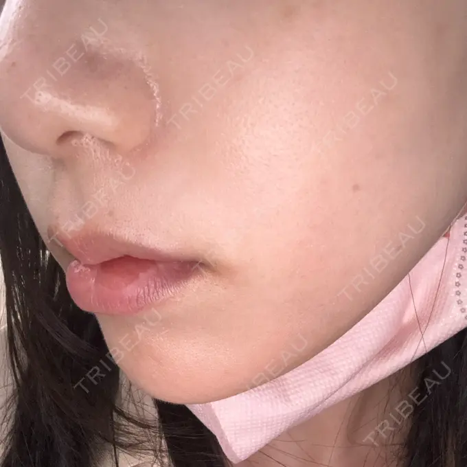 ルメッカ さっぽろ美容クリニック DAY 41 メイン用