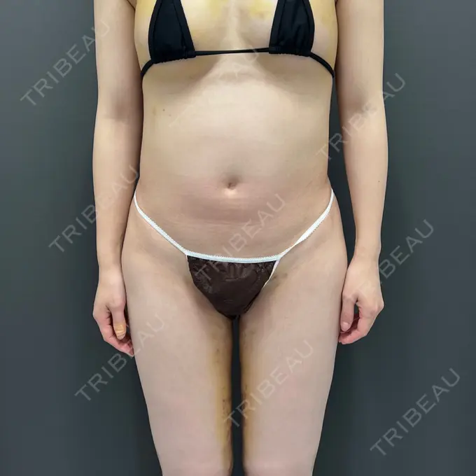 豊胸（脂肪注入） / その他（胸） plume clinic DAY 7 メイン用