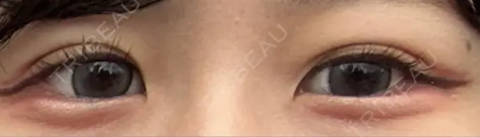 二重埋没 / 小鼻縮小（非切開） / ヒアルロン酸注入（涙袋） アリエル美容クリニック 横浜院 DAY 16 メイン用