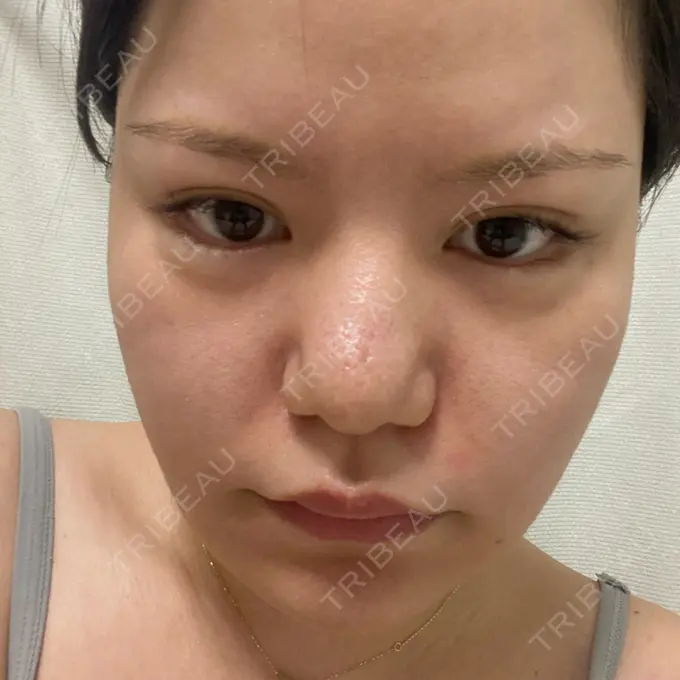 脂肪溶解注射（顔） SK新宿歌舞伎町美容外科・歯科 DAY 20 メイン用