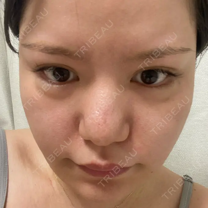 脂肪溶解注射（顔） SK新宿歌舞伎町美容外科・歯科 AFTER メイン用