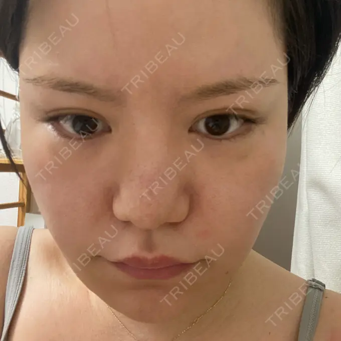 脂肪溶解注射（顔） SK新宿歌舞伎町美容外科・歯科 DAY 12 メイン用