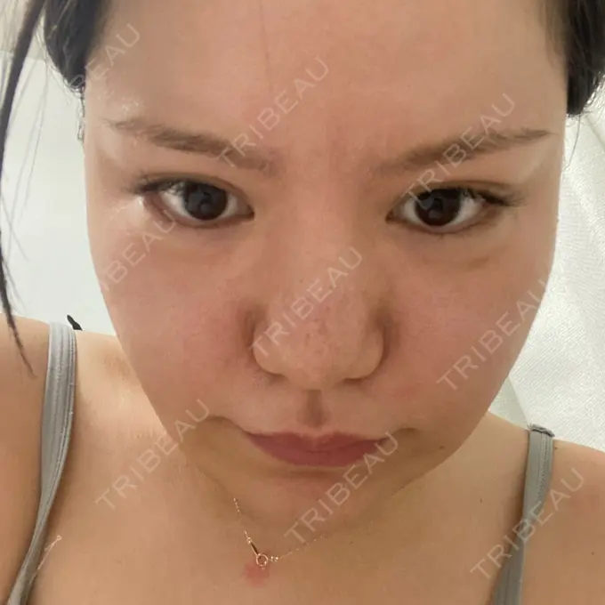 脂肪溶解注射（顔） SK新宿歌舞伎町美容外科・歯科 DAY 15 メイン用