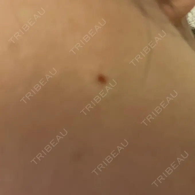 ほくろ・いぼ切除（肌） / 脂肪溶解注射（顔） 吉祥寺アイビークリニック DAY 0 メイン用