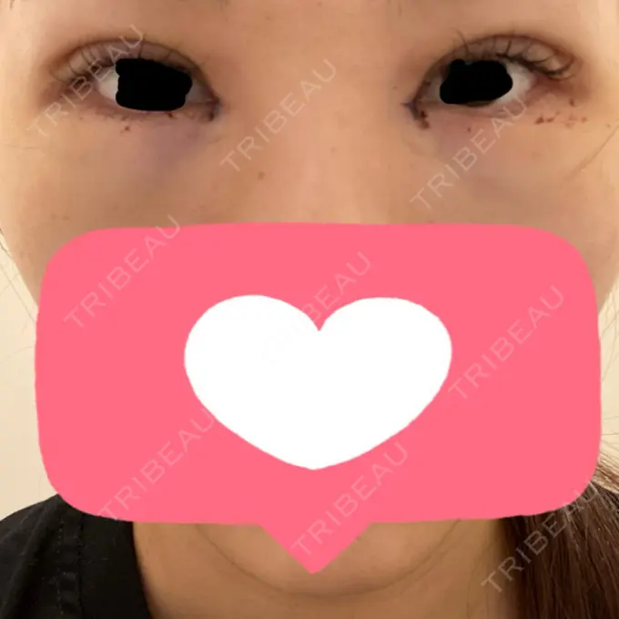 二重埋没 / 目頭切開 / クマ治療 HAAB BEAUTY CLINIC 名古屋院 DAY 1 メイン用