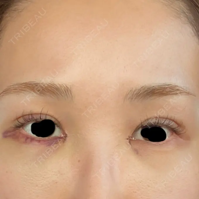 二重埋没 / 目頭切開 / クマ治療 HAAB BEAUTY CLINIC 名古屋院 DAY 3 メイン用