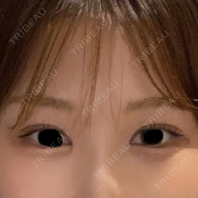 二重埋没 / 目頭切開 / クマ治療 HAAB BEAUTY CLINIC 名古屋院 AFTER メイン用