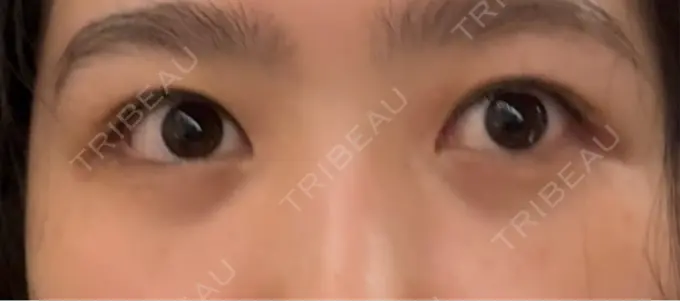 クマ治療 / 下まぶたの脂肪取り RIVER CLINIC（リバークリニック） DAY 10 メイン用