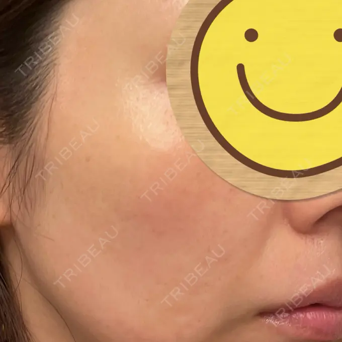 光治療（フォトフェイシャルなど） / ルメッカ Clinic K Blossom AFTER メイン用