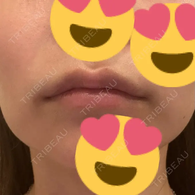 ヒアルロン酸注入（唇） 東京美容外科 名古屋院 DAY 3 メイン用
