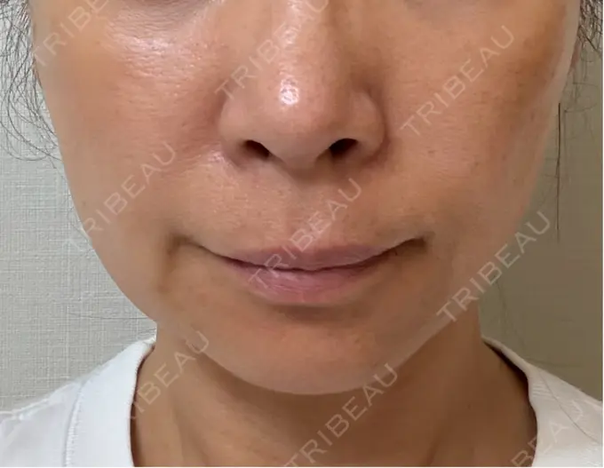 RF（高周波）たるみ治療 ゆきスキンクリニック 東池袋 AFTER メイン用