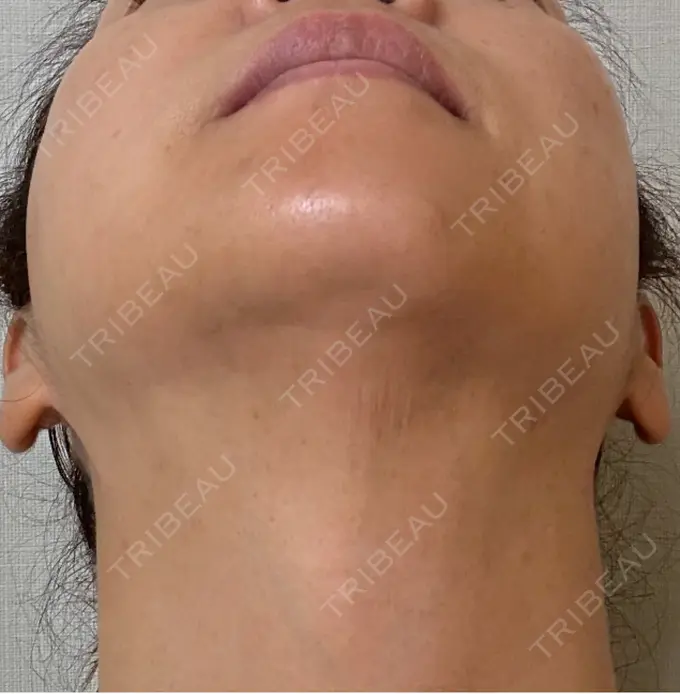 RF（高周波）たるみ治療 ゆきスキンクリニック 東池袋 DAY 7 メイン用