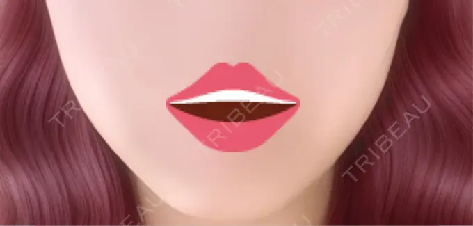 ボトックス（エラ・小顔） 共立美容外科 名古屋院 AFTER メイン用