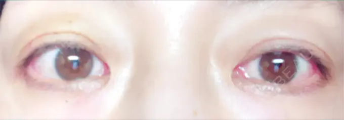 二重埋没 小倉美容外科ネビュラクリニック DAY 3 メイン用