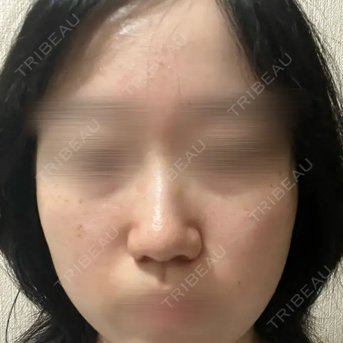 ルメッカ BITO BEAUTY CLINIC DAY 1 メイン用