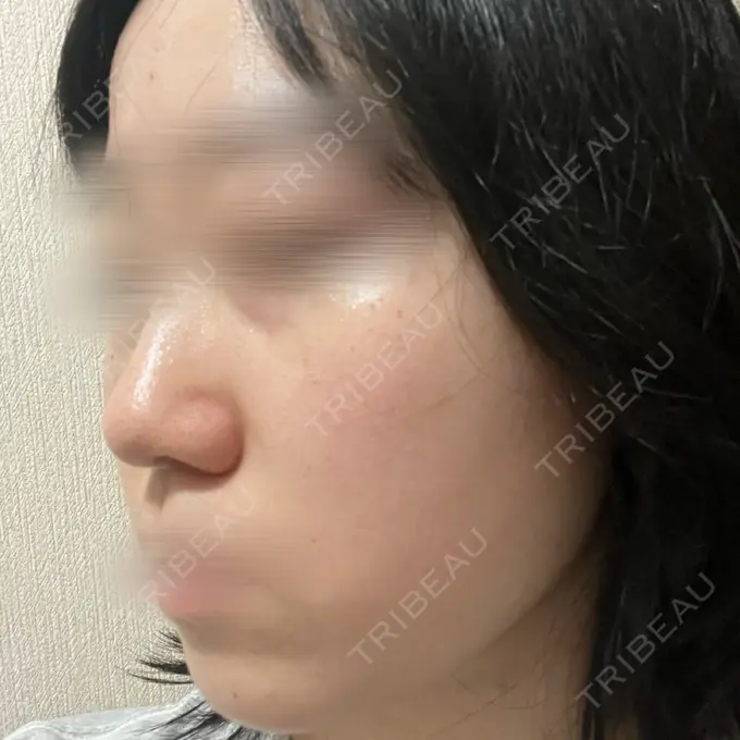 ルメッカ BITO BEAUTY CLINIC DAY 1 メイン用