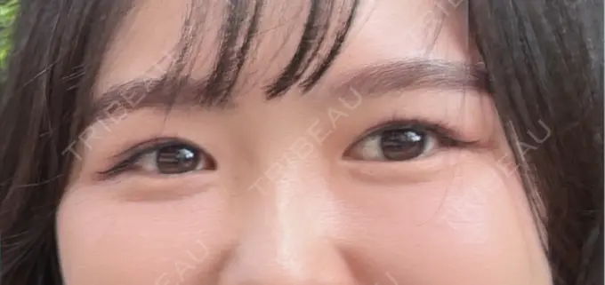 クマ治療 / 下まぶたの脂肪取り RIVER CLINIC（リバークリニック） AFTER メイン用