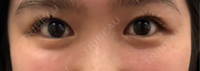 クマ治療 / 下まぶたの脂肪取り RIVER CLINIC（リバークリニック） DAY 12 メイン用