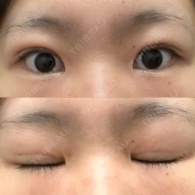 二重埋没 オアシス美容外科 AFTER メイン用