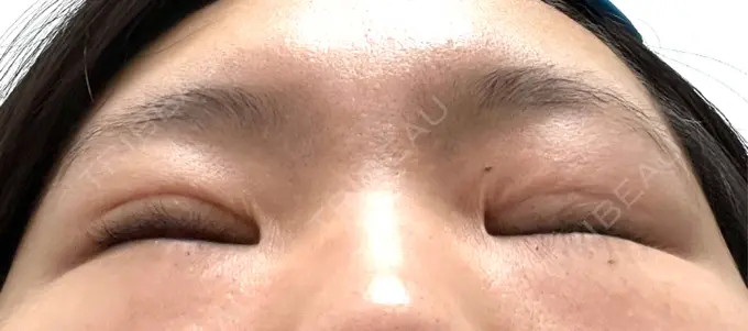 二重埋没 オアシス美容外科 DAY 58 メイン用