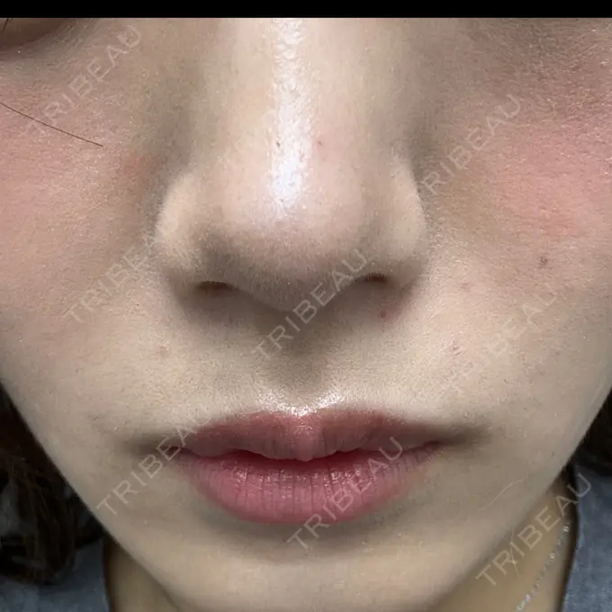 鼻尖形成（切開） ネビュラクリニック 京都院 AFTER メイン用